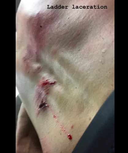 blessures de match d'échelle